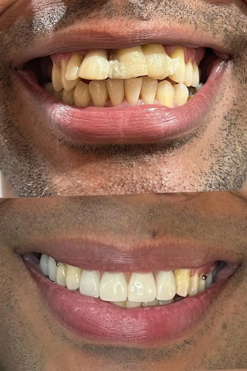 Antes e depois de reabilitação com prótese dentária: sorriso alinhado e uniforme após o tratamento