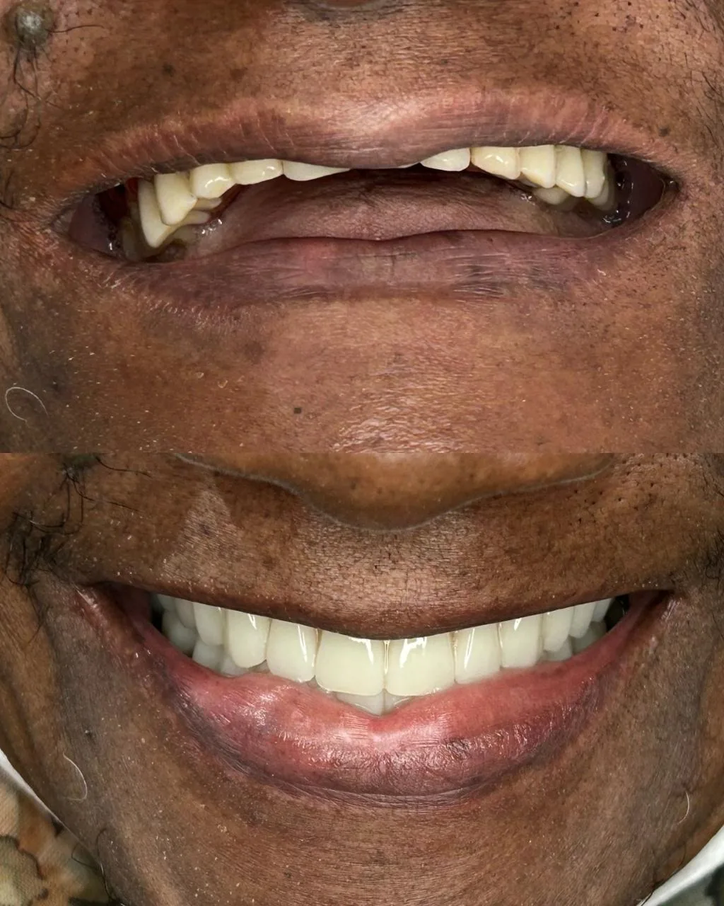 Antes e depois de tratamento protético: sorriso mais branco e alinhado