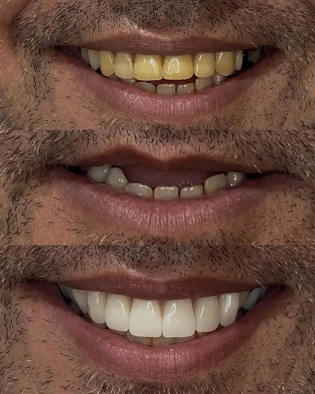 Sorriso antes e depois de tratamento com coroas dentárias na EuOdonto