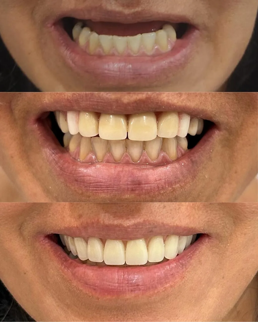 Resultado de prótese dentária: dentes escurecidos e desalinhados transformados em sorriso uniforme