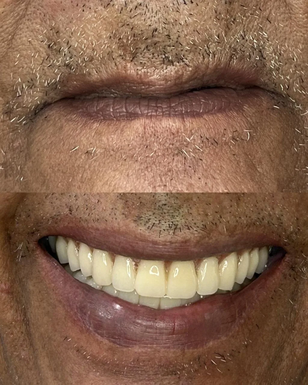 Antes e depois de reabilitação oral com prótese dentária realizada na EuOdonto