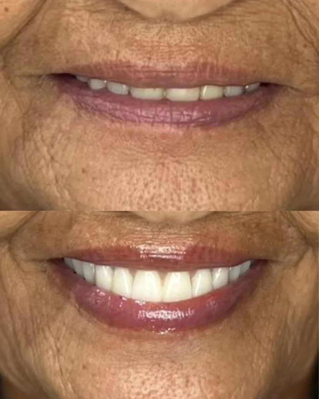 Sorriso renovado com prótese dentária: antes e depois do tratamento
