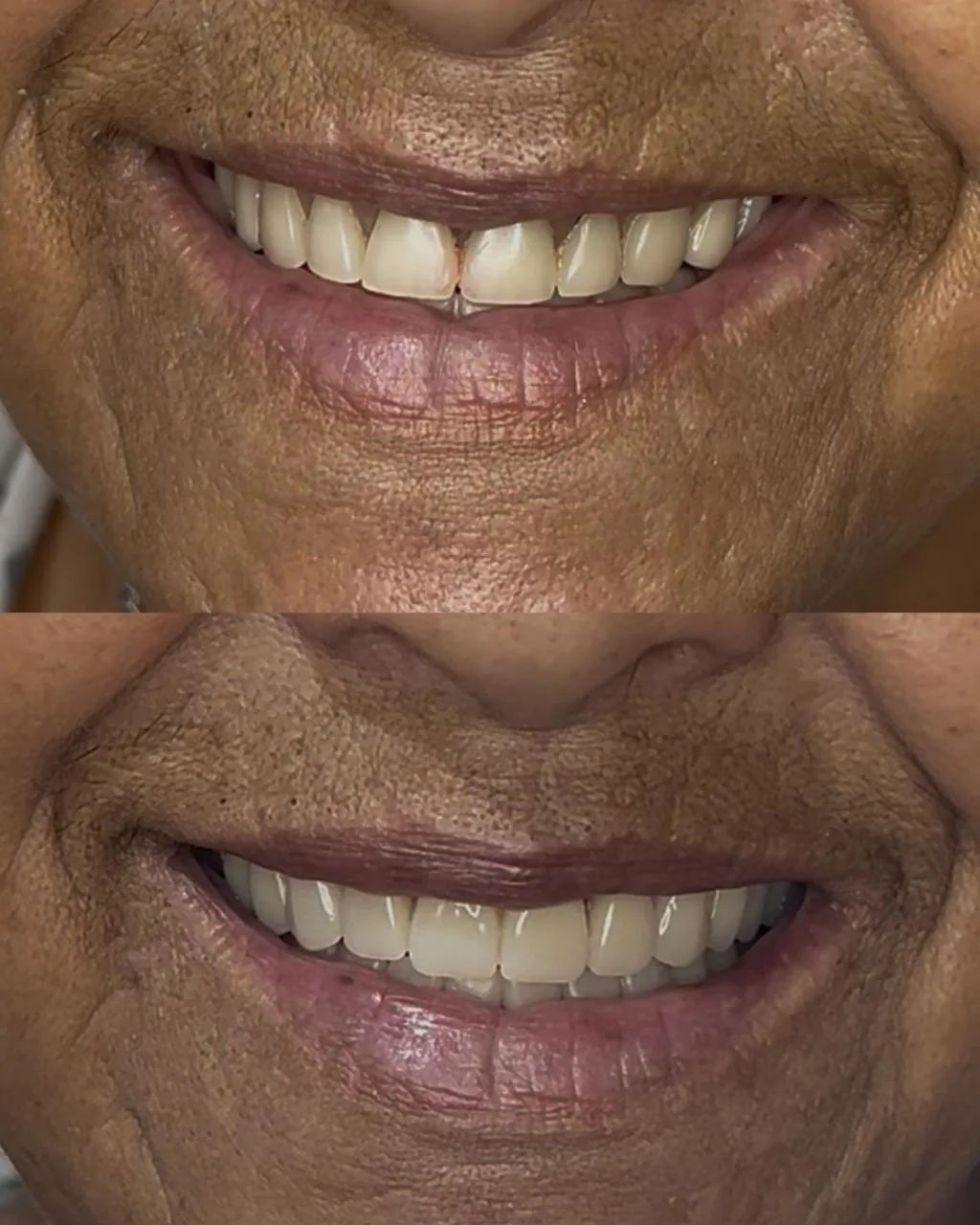 Transformação do sorriso com coroas e próteses dentárias na EuOdonto
