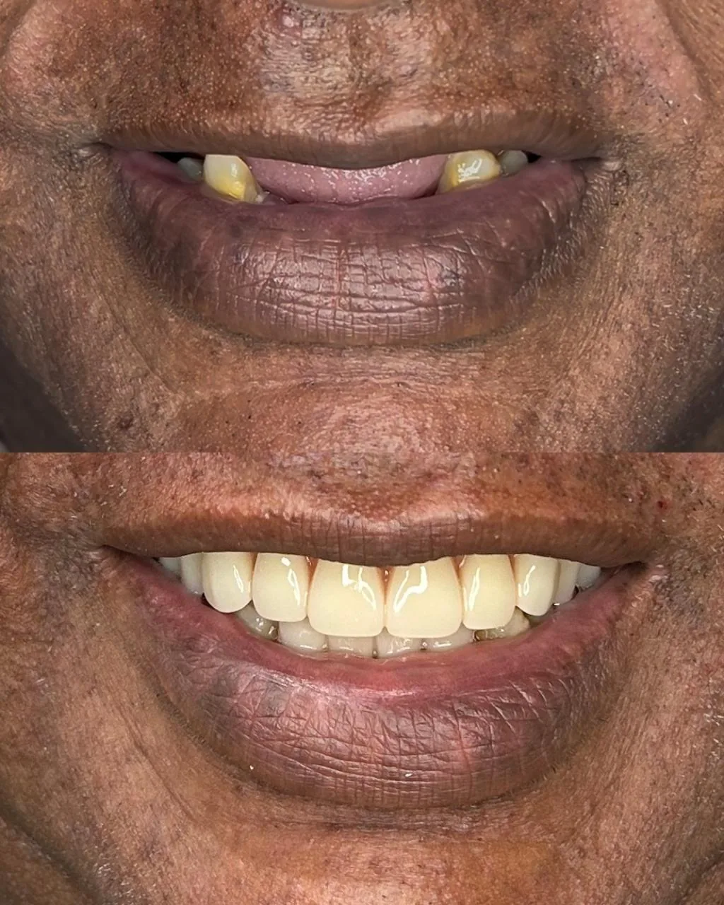 Antes e depois de tratamento com prótese dentária: dentes uniformes e alinhados