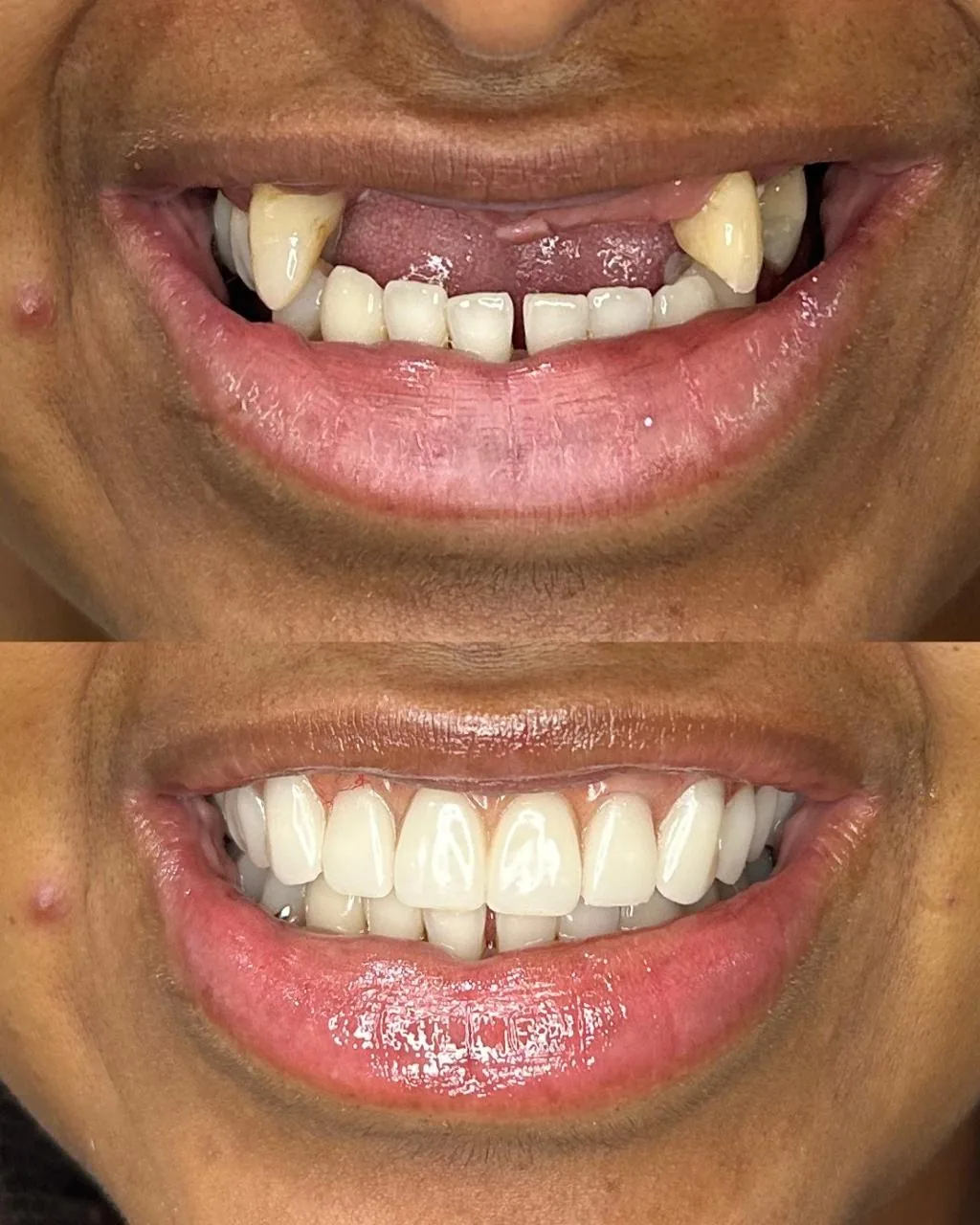 Reabilitação com prótese dentária: comparação entre antes e depois