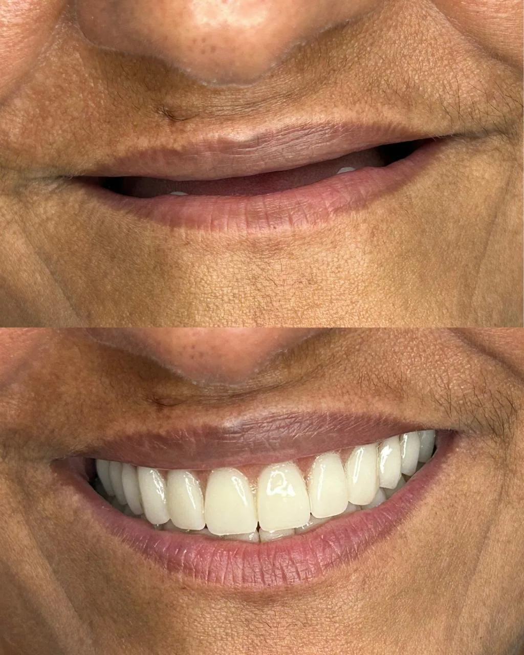 Sorriso após reabilitação com prótese dentária realizada na EuOdonto